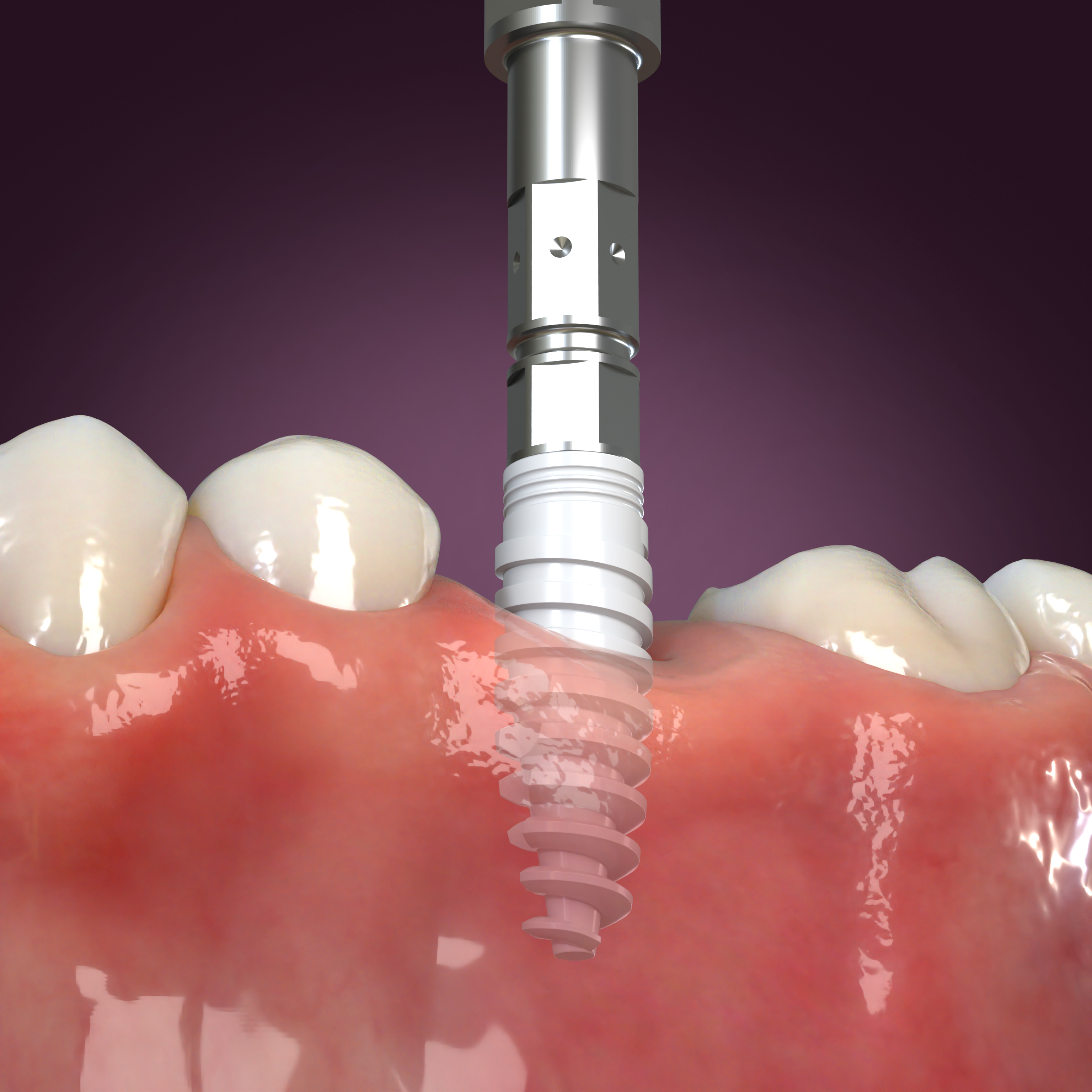 Ceramic Dental Implant